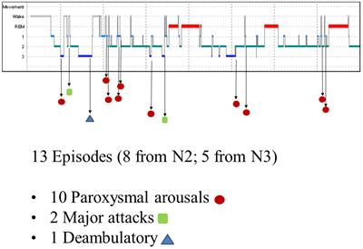 CHRNA2 and Nocturnal Frontal Lobe Epilepsy: Identification and Characterization of a Novel Loss of Function Mutation